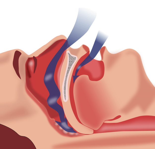 an illustration showing the obstruction of ventilation of a person with sleep apnea