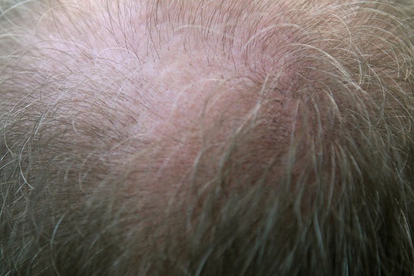 Do Biotin Supplements Regrow Lost Hair